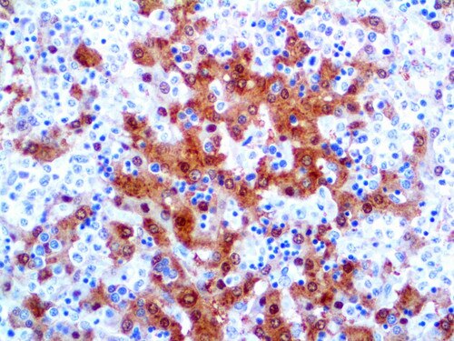 IHC of Arginase-1 on a FFPE Hepatocellular Carcinoma Tissue